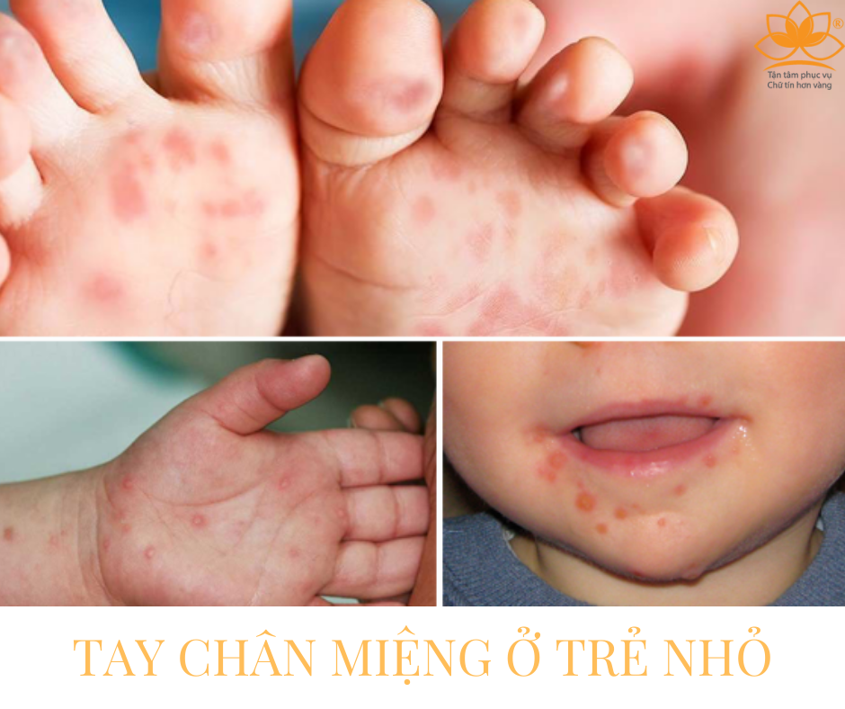 TAY-CHÂN-MIỆNG Ở TRẺ NHỎ